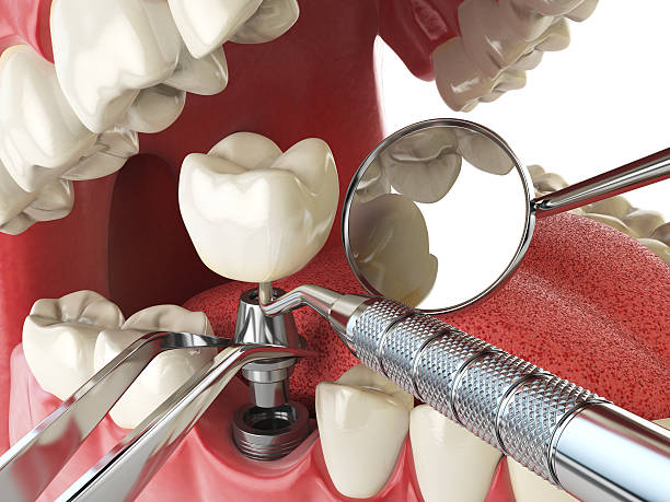 Best Emergency Wisdom Tooth Extraction in Hansville, WA